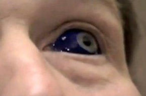 黒目整形 はどれくらい黒目が大きくなるんでしょうか 視力改善ポータルeye
